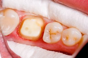dental-crown-process-3